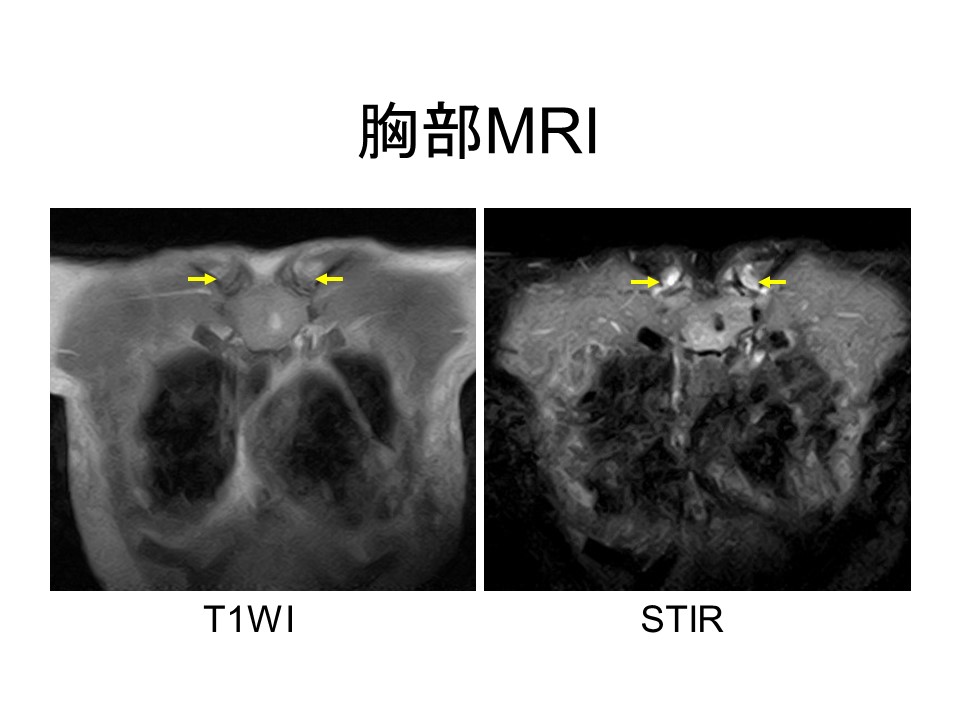 リウマチ性多発筋痛症あるある 4 となりの堤