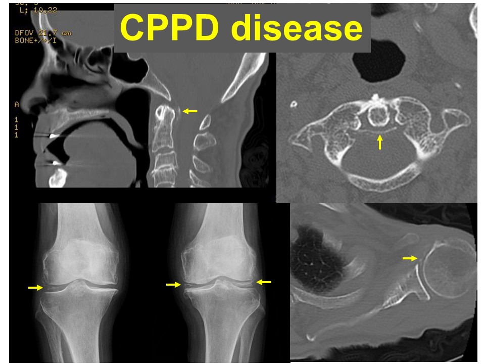 偽痛風の原因は何ですか?