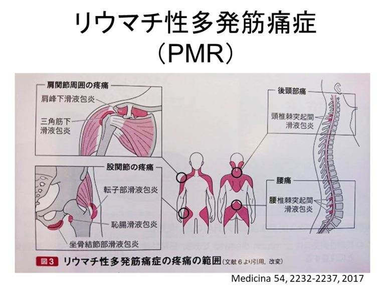 関節リウマチや線維筋痛症の症状は別の病気の兆候である可能性がありますか?