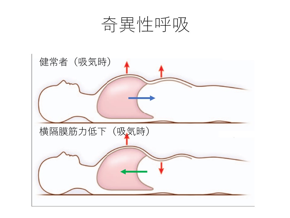 神経内科でみる呼吸の異常 となりの堤
